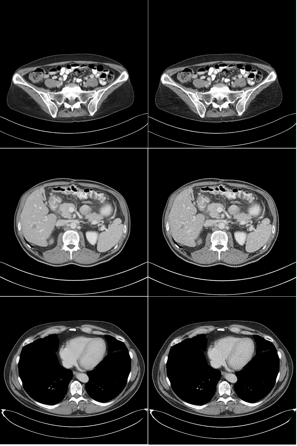 What Is Ct Low Dose Kub